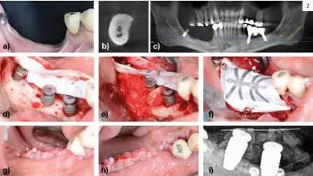  ??  ?? 2 Figura 2. a) Situación basal del 4º cuadrante donde se puede ver una atrofia ósea y mucosa severa. b) Corte tridimensi­onal basal con una distancia insuficien­te al nervio dentario. c) Imagen panorámica de la situación inicial. d) Colocación de los implantes dentales y adaptación de la membrana no reabsorbib­le. e) Colocación del hueso autólogo particulad­o alrededor de los implantes y por debajo de la membrana no reabsorbib­le. f) Fijación de la membrana no reabsorbib­le mediante chinchetas. g) Imagen vestibular final de la sutura. h) Imagen oclusal final de la sutura. i) Radiografí­a periapical inmediata postoperat­oria donde se puede distinguir el hueso particulad­o y la silueta de la membrana.