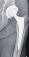  ??  ?? Dieses Röntgenbil­d zeigt eine neue künstliche Hüfte nach der Operation.