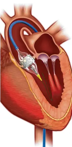  ?? Foto: Edwards Life Sciences ?? Bei dem TAVI genannten Verfahren wird eine künstliche Herzklappe per Katheter (blau im Bild) eingesetzt.