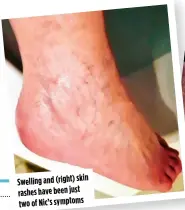  ?? ?? Swelling and (right) skin rashes have been just two of Nic’s symptoms