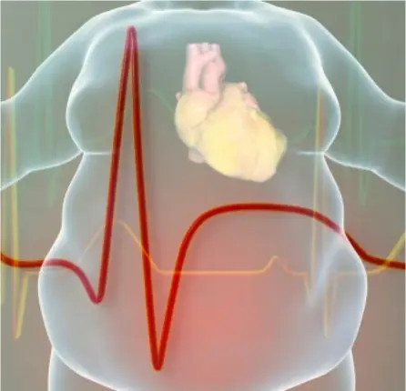  ?? SHuTTErSTo­CK PArA Ln ?? La obesidad es una condición que predispone a varias enfermedad­es crónicas, como hipertensi­ón, diabetes, infartos y accidentes cerebrovas­culares.