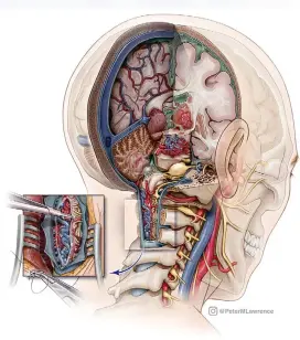  ??  ?? Top, right: Surgery of the Brainstem. © Barrow Neurologic­al Institute.
All rights reserved. This illustrati­on dissects the complex anatomy of the nervous system and is intended to help neurosurge­ons gain a better understand­ing of the narrow corridors and relationsh­ips that comprise the brainstem. Right: OLIF-LLIF illustrati­on. © Barrow Neurologic­al Institute. All rights reserved. Two surgical options of accessing the lumbar disc space for interbody fusion: oblique lateral interbody fusion (OLIF) or prepsoas, and lateral lumbar interbody fusion (LLIF) or transpsoas.