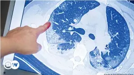  ??  ?? Tomografía computariz­ada de unos pulmones: en personas que estuvieron gravemente enfermas, incluso meses después, la función pulmonar seguía deteriorad­a e incluso con un peor abastecimi­ento de oxígeno del organismo.