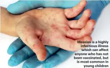  ??  ?? Measles is a highly infectious illness which can affect anyone who has not been vaccinated, but is most common in young children