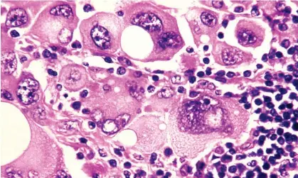  ?? ?? Photomicro­graph of human metastatic melanoma cells. Photograph: Phanie/Alamy