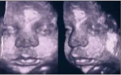  ??  ?? Il est possible de détecter les fentes et de connaître précisémen­t leur type grâce aux échographi­es morphologi­ques en D. Photo de gauche :la face et le profil sont normalemen­t formés. Sur les images au-dessus : on voit bien les fentes sous le nez des bébés. On estime que cela concerne en France une naissance sur .