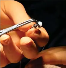  ??  ?? Précision. L’implant ressemble à une prothèse de hanche, en plus petit : 2,5 centimètre­s et 5 grammes.