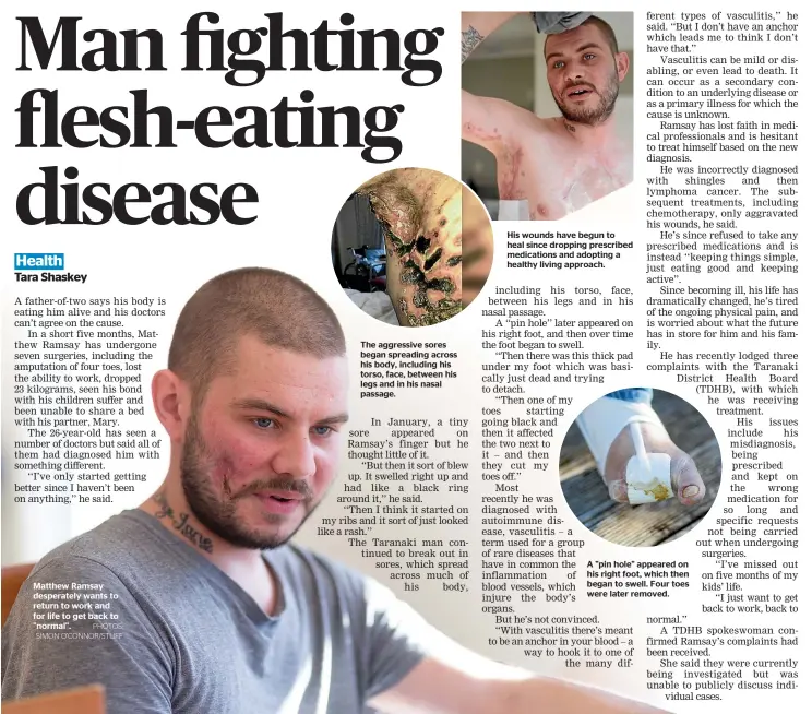  ?? PHOTOS: SIMON O’CONNOR/STUFF ?? Matthew Ramsay desperatel­y wants to return to work and for life to get back to "normal". The aggressive sores began spreading across his body, including his torso, face, between his legs and in his nasal passage. A "pin hole" appeared on his right...