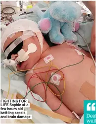  ?? ?? FIGHTING FOR LIFE Sophie at a few hours old battling sepsis and brain damage