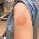  ?? PROVIDED BY DR. KIMBERLY BLUMENTHAL ?? A harmless but annoying rash appears on some people who have gotten the Moderna COVID-19 vaccine. A study says the reaction is not dangerous.