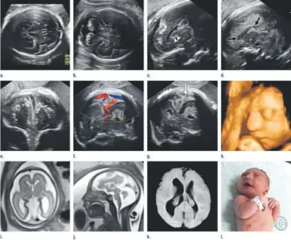 ??  ?? Images obtained in the case of a 34-year-old woman with a confirmed Zika virus infection show that fetal head circumfere­nce was in the normal range at 12 and 16 weeks but decreased to the 10th percentile at 22 weeks and was below the 3rd percentile in...