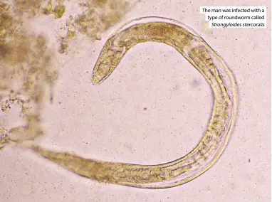  ?? ?? The man was infected with a type of roundworm called Strongyloi­des stercorali­s