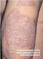  ??  ?? Plaque psoriasis is the most common form of
this skin condition