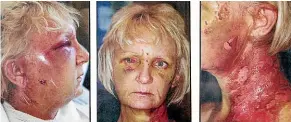  ??  ?? Wendy Hamer suffered horrific injuries when she was punched, kicked, stabbed and scalded during a ‘‘frenzied’’ 40-minute attack.