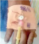  ??  ?? Cannula on a patient to administer saline or medication. The elastoplas­t is not transparen­t, so it is difficult to spot any redness which would indicate an infection