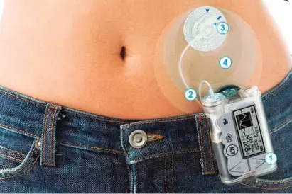  ?? FOTO ?? El dispositiv­o es discreto. Se puede usar en distintas partes del cuerpo para monitorear la glucosa y activar el suministro de insulina según necesidad.
