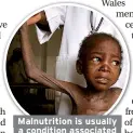  ??  ?? Malnutriti­on is usually a condition associated with countries living in poverty