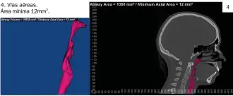  ??  ?? 4. Vías aéreas. Área mínima 12mm2.