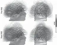  ??  ?? This image shows brain activity in a patient before, top row, and after vagus nerve stimulatio­n. The darker tones indicate an increase of connectivi­ty.