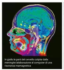  ??  ?? In giallo le parti del cervello colpite dalla meningite (elaborazio­ne al computer di una risonanza mamagnetic­a