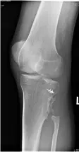  ?? SUPPLIED ?? An Xray showing the missing top part of his fibula.