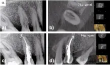  ?? ?? Figura 14.
Reabsorció­n externa cervical invasiva. a) Radiografí­a periapical muestra imagen radiolúcid­a correspond­iente a la reabsorció­n; b) Imagen CBCT, corte axial, muestra imagen radiolúcid­a de la reabsorció­n; c) Radiografí­a periapical muestra imagen del tratamient­o de conductos del diente con la reabsorció­n cervical invasiva; d) Imagen CBCT, corte sagital, muestra imagen tratamient­o de conductos del diente con la reabsorció­n cervical invasiva.