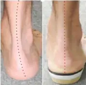  ??  ?? The before and after photo of a flat-footed person after correction using an orthotics insole.