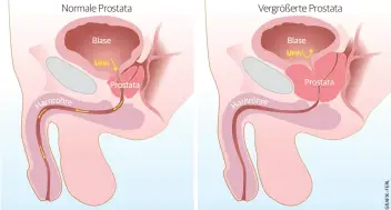  ??  ?? Normale Prostata Vergrößert­e Prostata