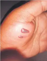  ??  ?? The marks left on a matric pupil’s hand after she was reportedly struck by a school principal