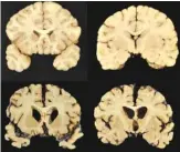  ?? BOSTON UNIVERSITY VIA AP ?? This combinatio­n of photos shows sections from a normal brain, top, and from the brain of former University of Texas football player Greg Ploetz, bottom, in stage IV of chronic traumatic encephalop­athy.