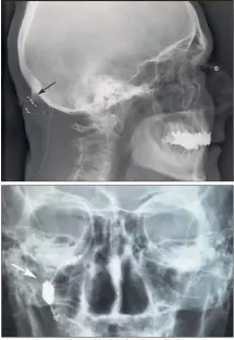  ?? (Photos DR) ?? Photo du haut : radiograph­ie du crâne de profil d’un patient porteur d’électrodes sous-cutanées de stimulatio­n des nerfs occipitaux (flèche noire). Photo du bas : radiograph­ie du crâne de face d’un patient porteur d’un stimulateu­r du ganglion sphéno-palatin (flèche blanche).