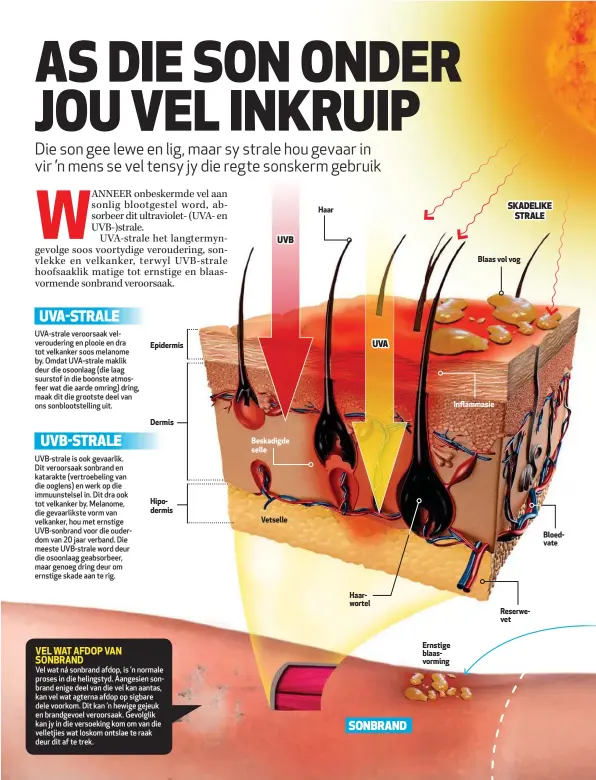  ?? UVB UVA SKADELIKE STRALE ?? Epidermis Dermis Hipodermis Beskadigde selle Vetselle Haar Haarwortel Ernstige blaasvormi­ng Blaas vol vog Inflammasi­e Reserwevet Bloedvate