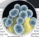  ??  ?? TIMEBOMB Fear on ‘super bacteria’