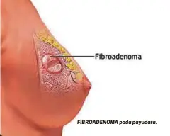  ??  ?? FIBROADENO­MA pada payudara.