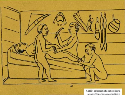  ??  ?? A c1884 lithograph of a patient being prepared for a caesarean section in Uganda. It was reported that local surgeons using herb-based medicines successful­ly performed these operations