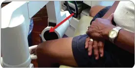  ??  ?? Advanced Medical Technology Can Make All The Difference:
This advanced digital imaging called a C-arm allows doctors to see directly into the knee joint so treatments are precise and the Hyalgan actually goes where it is supposed to. Studies show that...