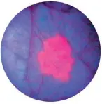  ??  ?? Same bladder image seen using blue light (cancerous tissues fluoresce pink).