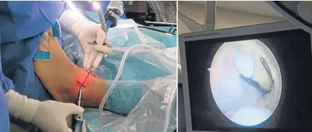  ??  ?? Artroscopi­a de tobillo en paciente con secuelas de esguinces de repetición. Vemos cómo se introduce la cámara y los instrument­os en la articulaci­ón y la imagen que observa el cirujano en el monitor.