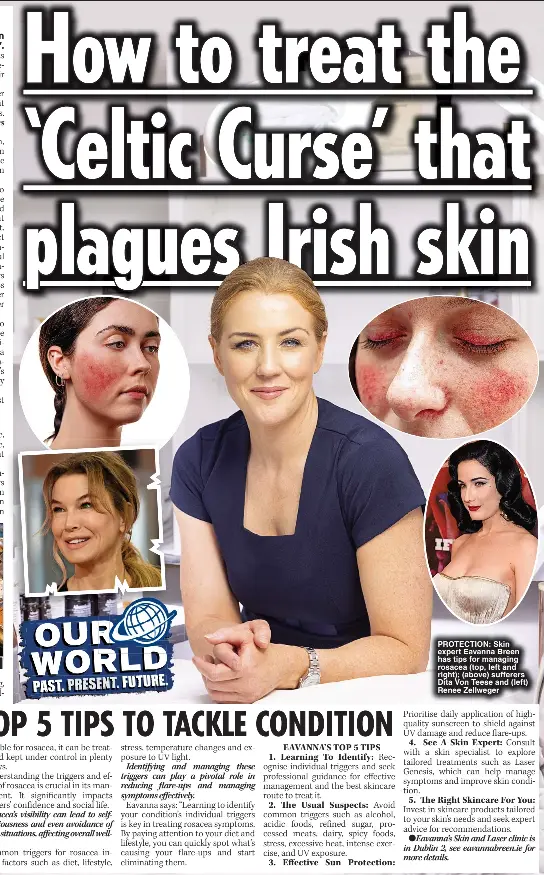  ?? ?? PROTECTION: Skin expert Eavanna Breen has tips for managing rosacea (top, left and right); (above) sufferers Dita Von Teese and (left) Renee Zellweger