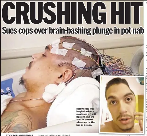  ??  ?? Bobby Lopez was hospitaliz­ed for a month and left with lopsided skull (r.) after he tumbled when cops tackled him on a stoop.