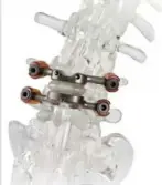  ?? Courtesy of Premia Spine ?? The TOPS system artificial joint for the spine was tested in Pittsburgh and approved by the FDA in June.