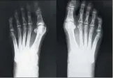  ?? (DR) ?? L’hallux valgus est une pathologie majoritair­ement féminine qui s’opère bien : l’interventi­on réduit la gêne et la douleur liée au chaussage.