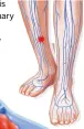  ?? ?? Deep vein thrombosis can lead to a pulmonary embolism, which obstructs blood flow in the lungs