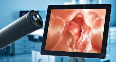  ?? ?? LOOKING UP: A probe with a camera can spot suspicious-looking tissue in the colon in real time