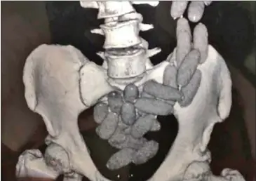  ?? SUPPLIED ?? An image of a digital body scan showing multiple packages of cocaine in the body of a South African national who was caught by the authoritie­s at Phnom Penh Internatio­nal Airport last week.