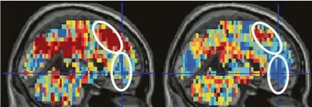  ?? Carnegie Mellon University / Tribune News Service ?? The brain scan related to the word “death” in participan­ts who had made a suicide attempt, left, shows greater activation in areas associated with thoughts of self than the scan for control participan­ts, right.