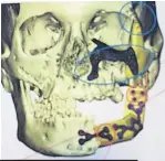  ??  ?? Images show extent of damage to Gaelle’s jawbone and how surgeons reconstruc­ted it with part of fibula
