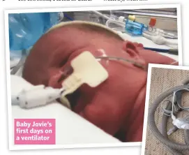  ??  ?? Baby Jovie’s first days on a ventilator