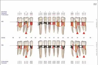  ??  ?? Figura 2.1.- Exploració­n peridontal. Peridontog­rama superior. Figura 2.2.- Exploració­n periodonta­l. Peridontog­rama inferior. 2.2