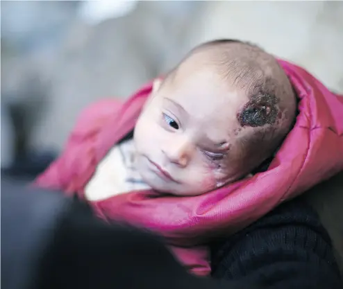  ?? AMER ALSHAMI / ANADOLU AGENCY / GETTY IMAGES ?? Three-month- old Syrian baby Karim lost his left eye, and his mother, after a government bomb attack in a market in Ghouta. Later, in another attack from Assad’s forces, shrapnel tore through his house, crushing his skull.